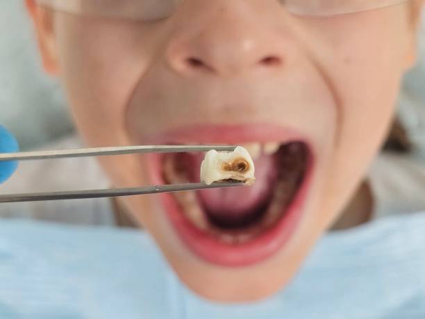 Best Emergency Gum Treatment in Mount Vernon, WA