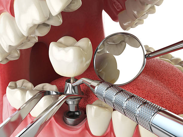 Best Emergency Tooth Extraction in Mount Vernon, WA